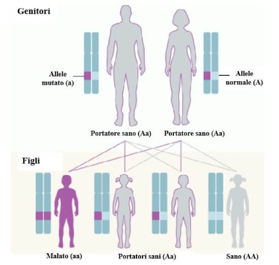 anemia falciforme