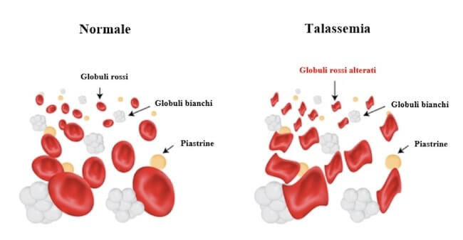 Anemia mediterranea