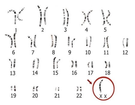 cariotipo sindrome di turner