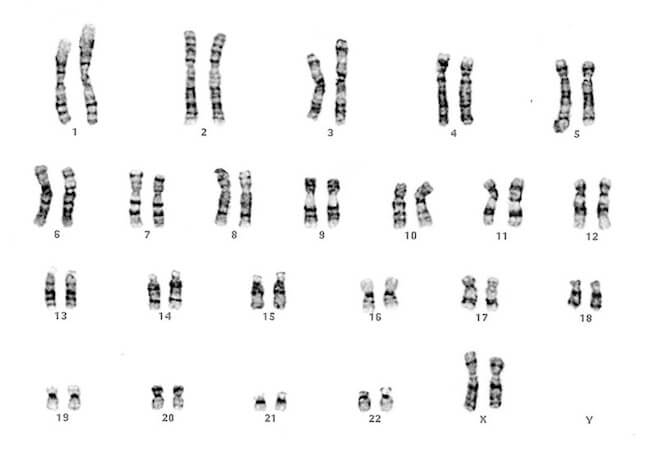 Cariotipo umano di un individuo di sesso femminile