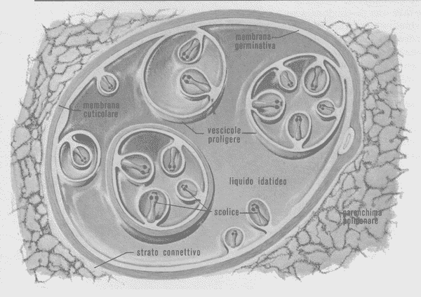 Cisti da echinococco