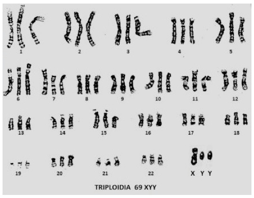 Corredo cromosomico triploide