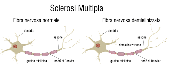 Differenza tra una fibra nervosa normale (mielinizzata) e una fibra nervosa demielinizzata