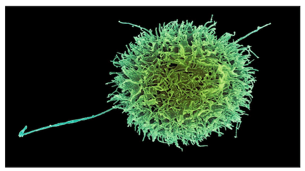 Linfocita NK: cellula natural killer