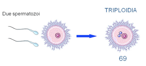 Triploidia