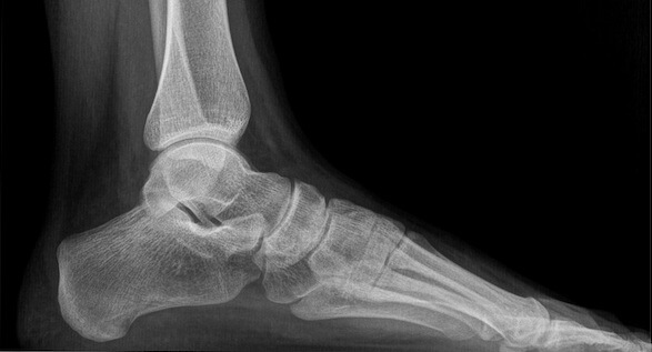 Radiografia di un piede