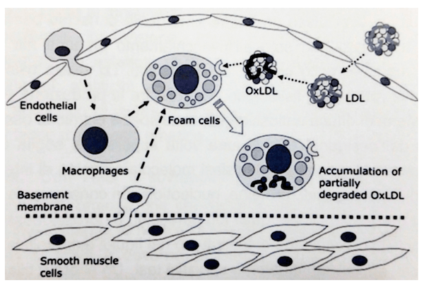 Formazione di una placca aterosclerotica